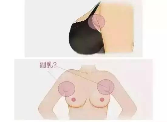 腋下难看的那两坨肉，可以转变为乳房吗？
