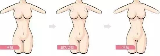 腋下难看的那两坨肉，可以转变为乳房吗？