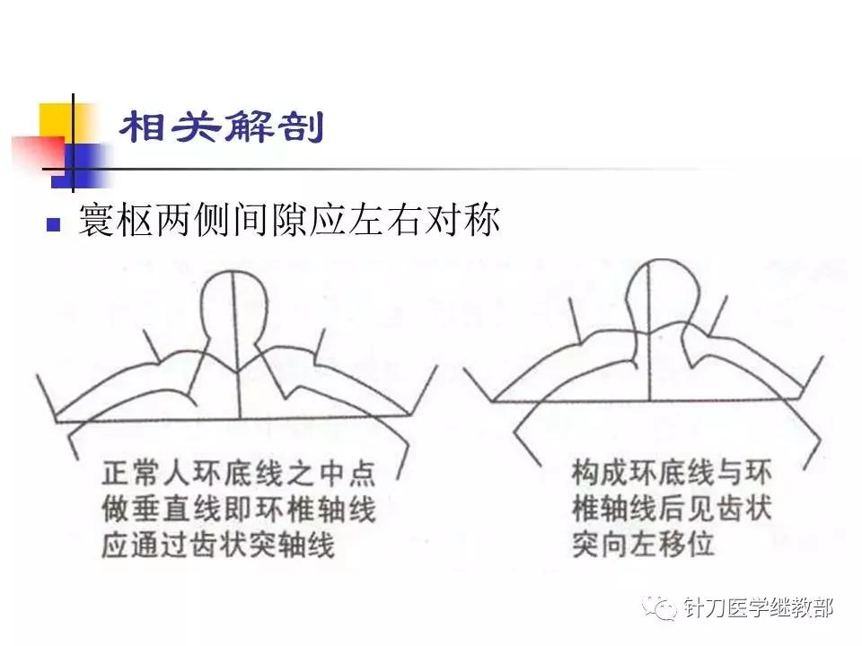 椎动脉型颈椎病错位了怎么治疗,颈椎寰枢关节错位复位手法