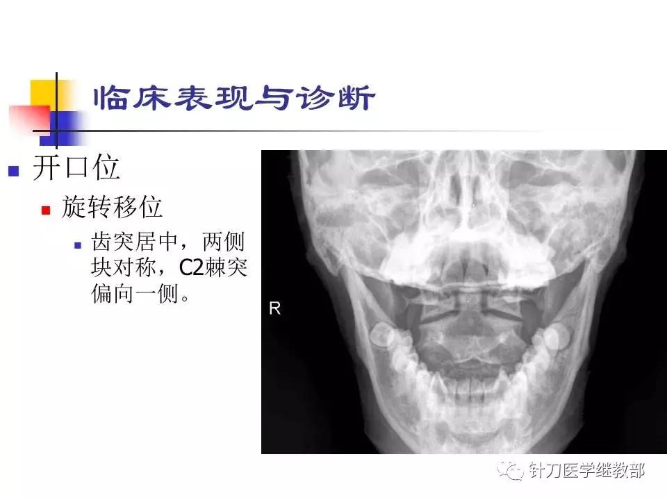 椎动脉型颈椎病错位了怎么治疗,颈椎寰枢关节错位复位手法