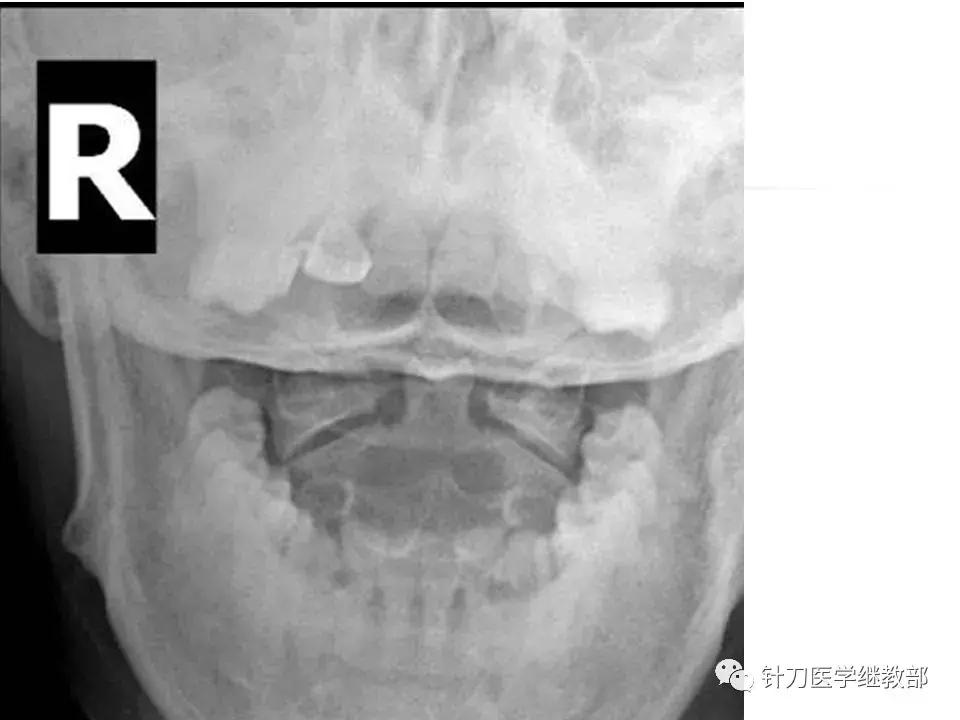 椎动脉型颈椎病错位了怎么治疗,颈椎寰枢关节错位复位手法