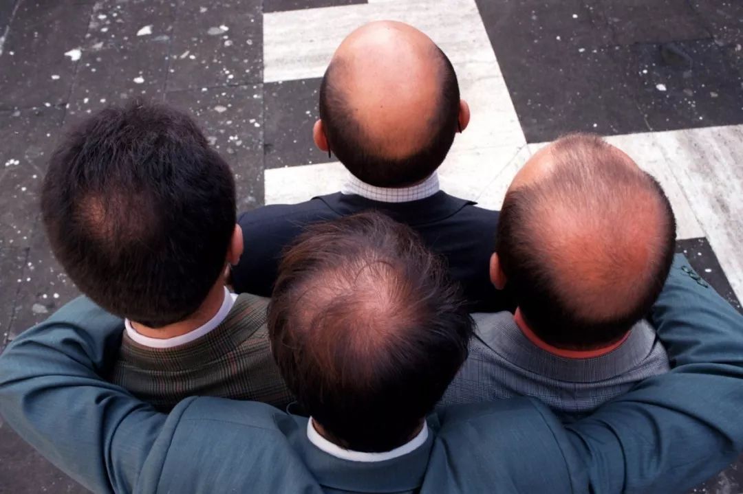 产后防脱发最好的偏方,生姜防脱发最有效的偏方