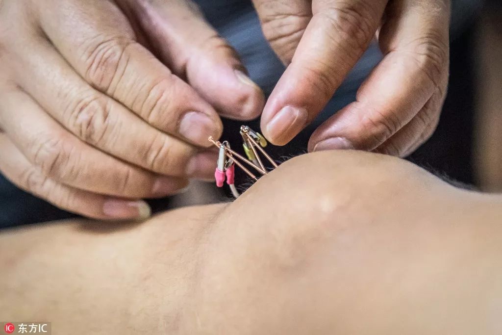 超·广角｜足坛神医严诚——细“针”密缕匠人精神