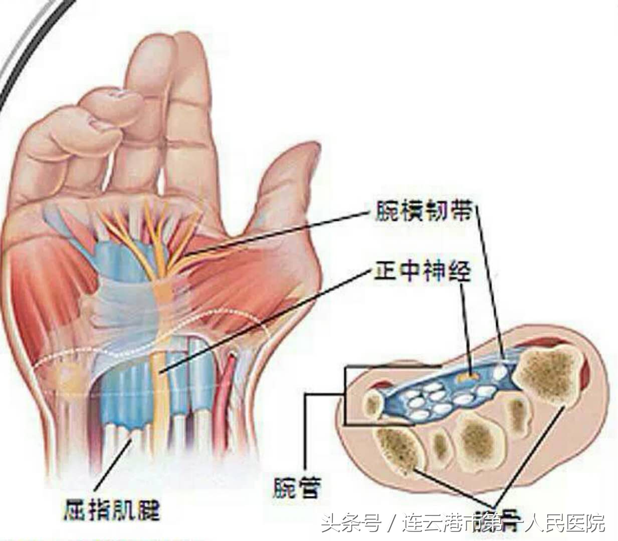 腕管综合征治疗特效药,腕管综合征做手术能彻底的好吗