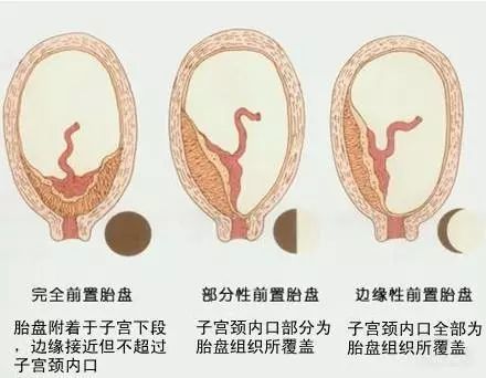 胎盘低置很危险吗,12周胎盘低置