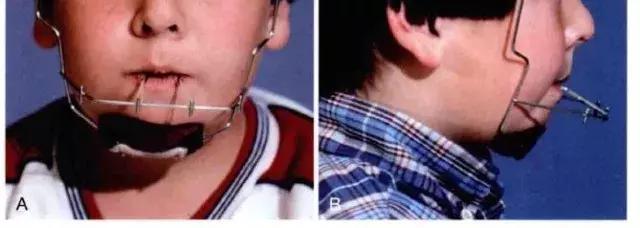 为什么牙齿矫正堪比整形,牙齿矫正堪比整容