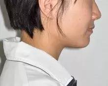 为什么牙齿矫正堪比整形,牙齿矫正堪比整容