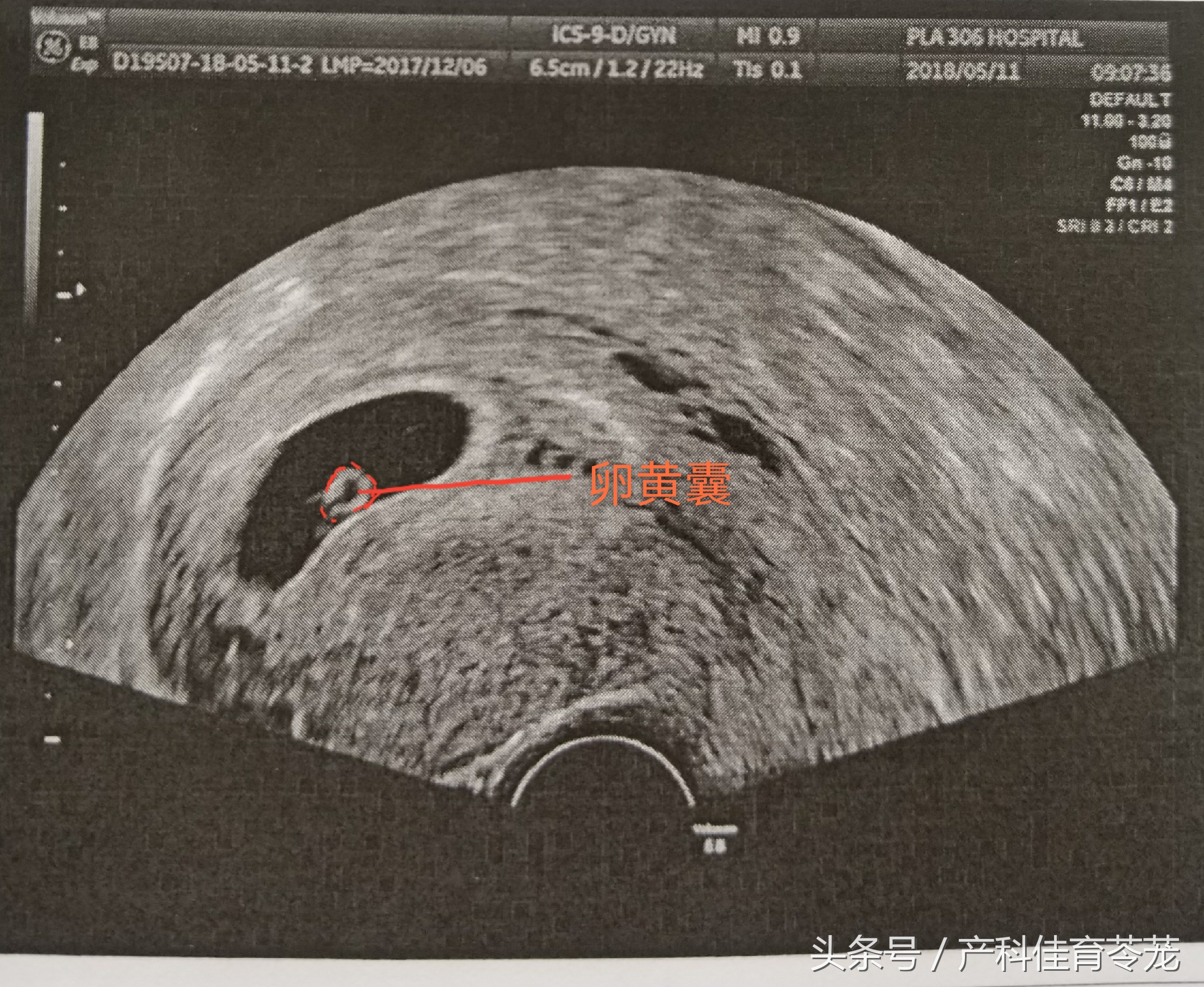 产科彩超报告解读,教您看懂产科超声报告