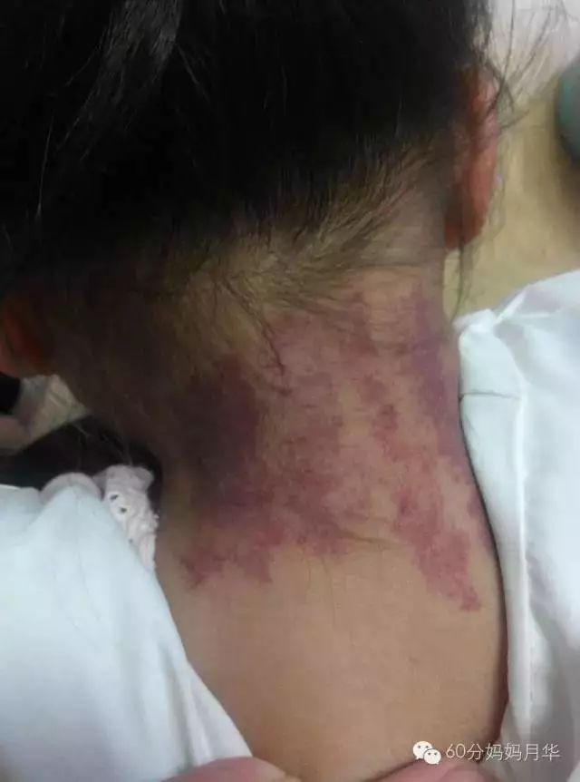 扁桃体炎引起的高烧不退咽喉脓肿,只能靠吃药吗?!