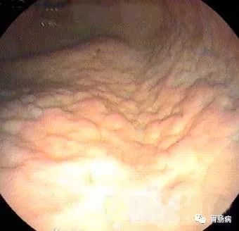 慢性胃炎30个常见问题,关于胃炎的治疗方法