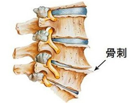 腿长骨刺怎么治,长骨刺打什么针