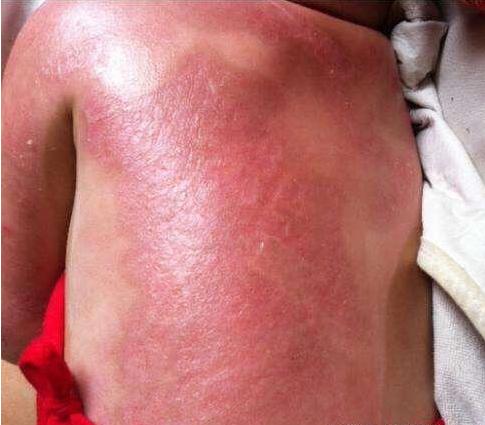 一岁小孩二级烫伤会怎么样,宝宝二级烫伤多久可以恢复到正常