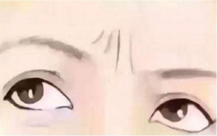 川字纹的科普,川字纹是怎么引起的