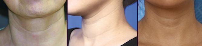 有颈纹怎么消除简单方法真实有效,颈纹可以怎么治疗