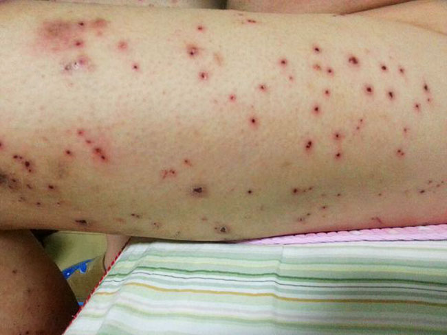 孕妇维c吃多了对胎儿的危害,服用维c对肾脏的伤害