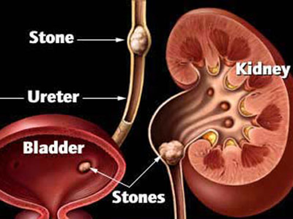 孕妇维c吃多了对胎儿的危害,服用维c对肾脏的伤害