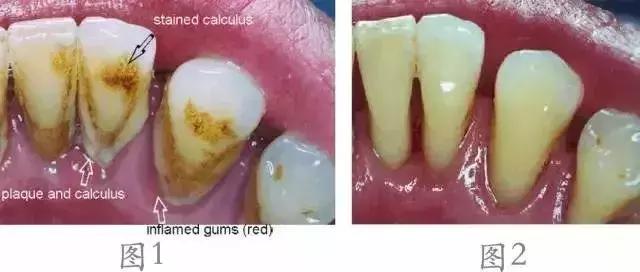 牙龈碰到说不出的难受是怎么回事,牙龈一碰就疼不碰没事是咋回事