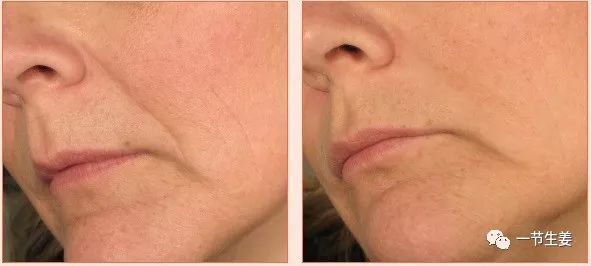法令纹全部填平,美颜都掩盖不了脸上的法令纹