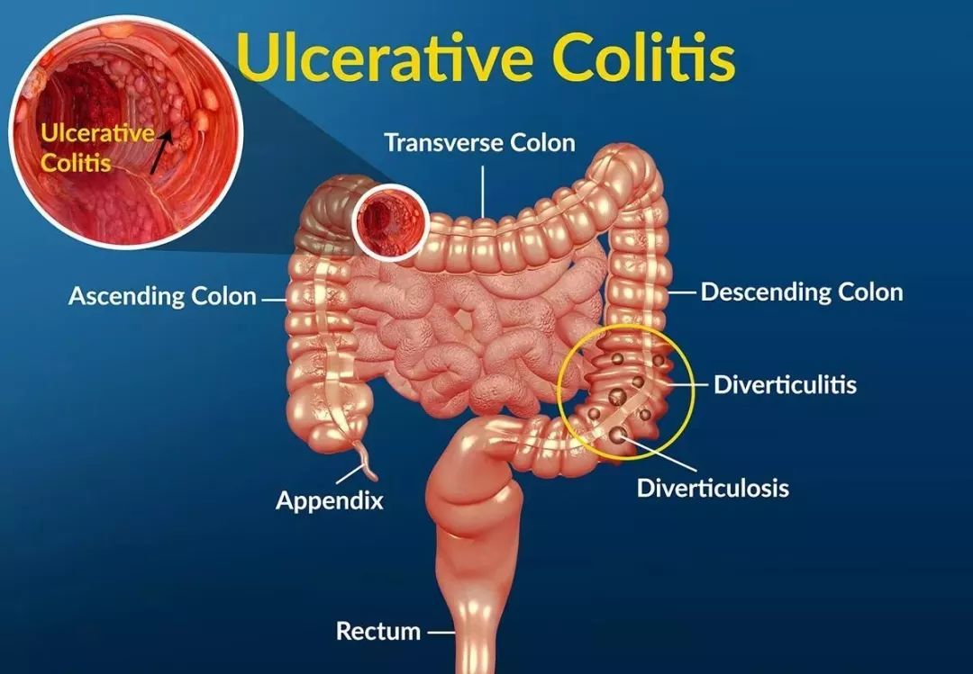 溃疡性结肠炎有没有治好的案例,一个用中药治好慢性结肠炎的案例