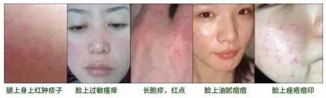 每晚6000000螨虫陪你睡？用它喷一喷，彻底除螨！