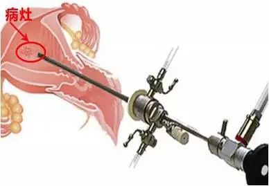 妇科医生的第三只眼——宫腔镜