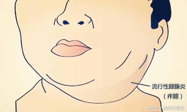 流行性腮腺炎饮食,流行性腮腺炎早期中期后期饮食