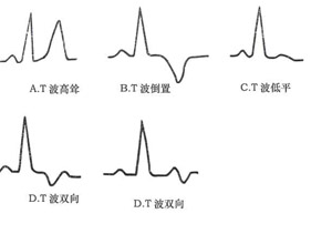 有多少人心电图有异常,心电图t波v3至v6异常是什么意思