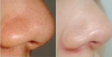 有效快速去黑头的小妙招,怎么去黑头小窍门8招简单有效