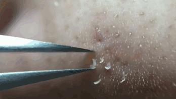 有效快速去黑头的小妙招,怎么去黑头小窍门8招简单有效