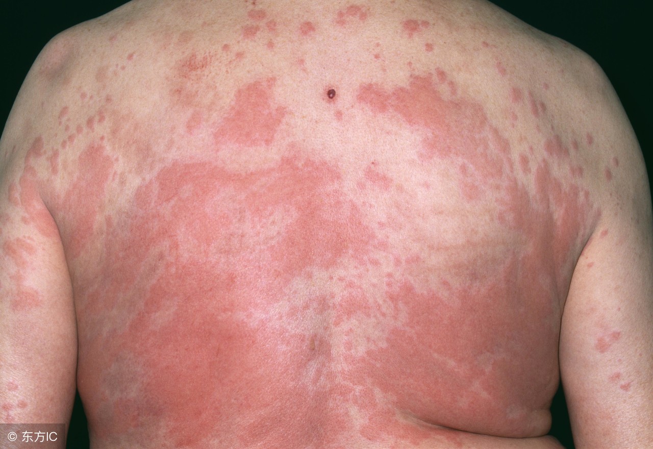 治疗哮喘合并过敏性鼻炎的药物,治疗过敏性鼻炎哮喘的药物有哪些