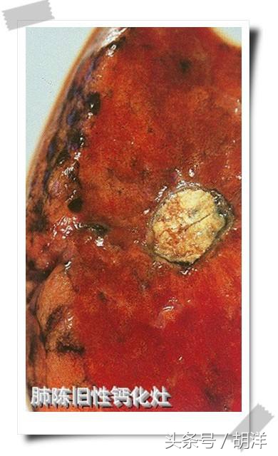 肺结核钙化会转成肺癌吗,肺结核病灶已经钙化是怎么回事