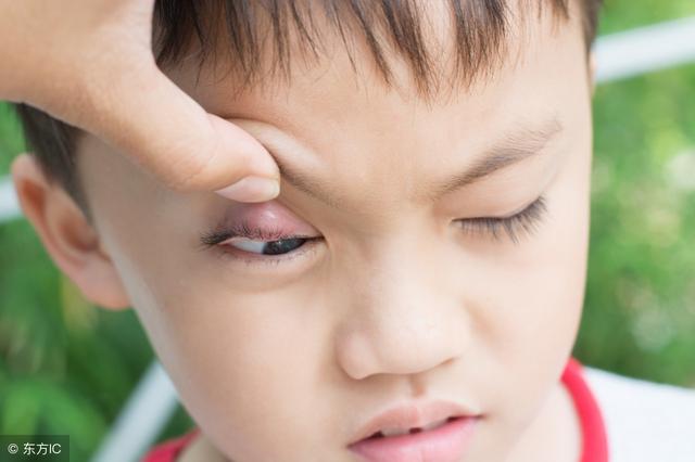 轻视小儿麦粒肿带来终生伤害,小小麦粒肿