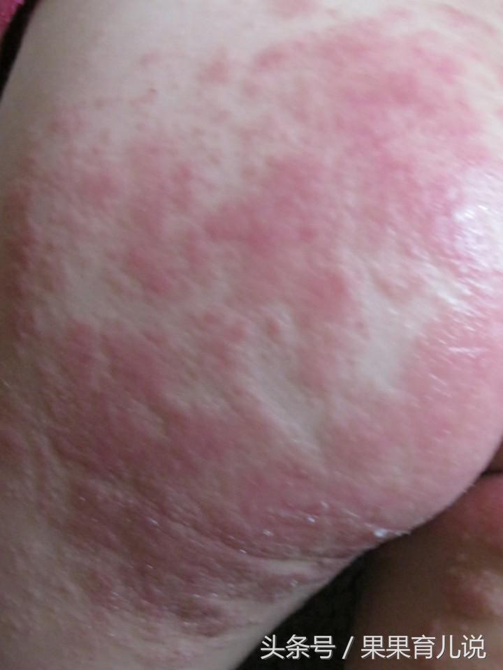 宝宝屁屁红还起了泡泡什么原因,宝宝屁屁红得发亮