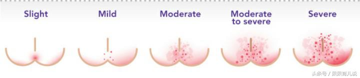 宝宝屁屁红还起了泡泡什么原因,宝宝屁屁红得发亮