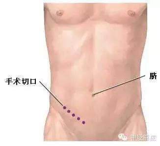 割阑尾历史,医疗故事切盲肠