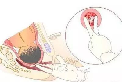 怀孕如何判断顺产还是剖腹产,几周产检决定顺还是剖