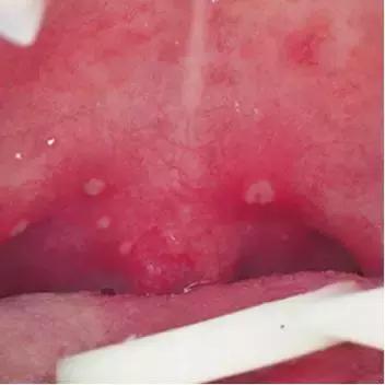 口腔疱疹发热怎么办,小孩发热口腔有疱疹