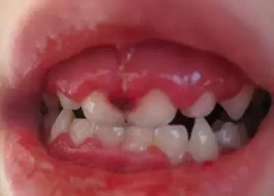 口腔疱疹发热怎么办,小孩发热口腔有疱疹