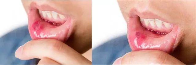 一秒止痛口腔溃疡,口腔溃疡药5秒止痛