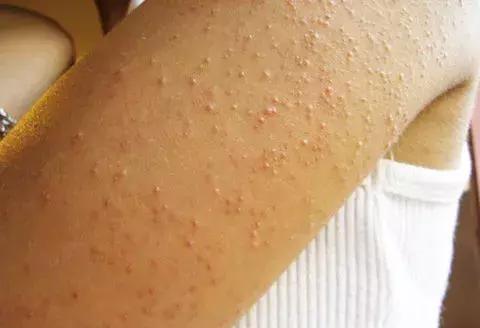 鸡皮肤夏天怎么遮盖鸡皮肤,鸡皮肤不敢穿短袖怎么办