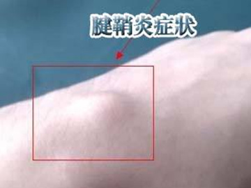 大拇指腱鞘炎症状和治疗,正确的腱鞘炎锻炼方式