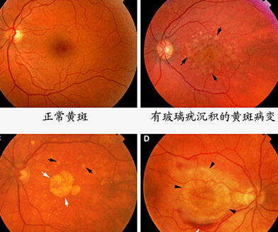 黄斑病变是什么？该如何治疗？