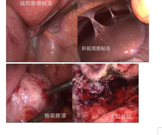 盆腔炎小便疼痛是怎么回事,月经后盆腔炎严重怎么回事