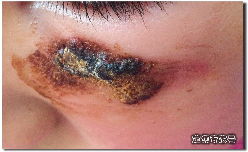 小孩摔伤防留疤擦芦荟胶可以吗,孩子受伤妈妈擦药