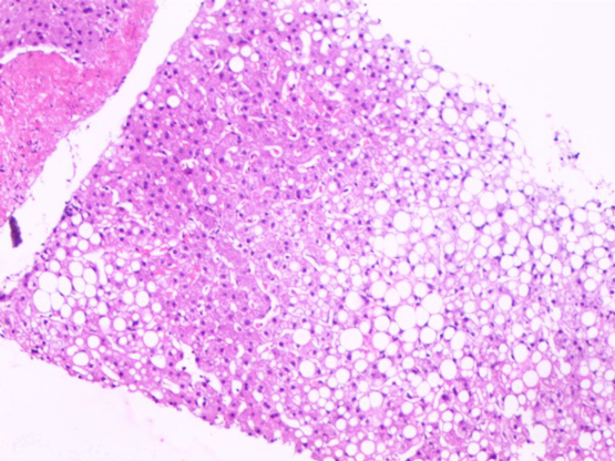 肝脏穿刺活检时容易伤到膈肌吗,肝脏穿刺检查痛不痛
