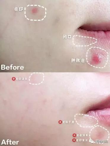 “战痘”前任与现任