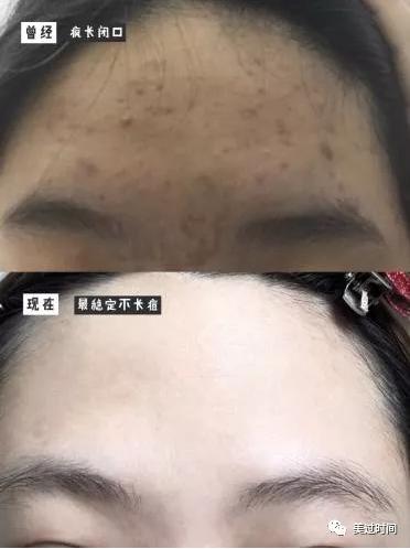 “战痘”前任与现任