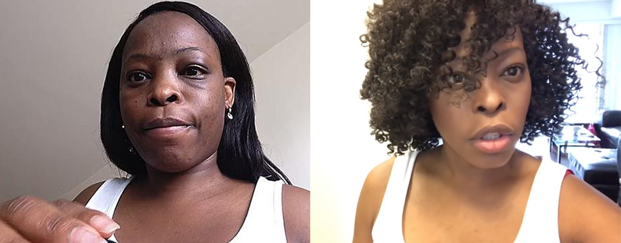 吸脂减肥前后对比图片,吸脂减肥全部过程视频术后