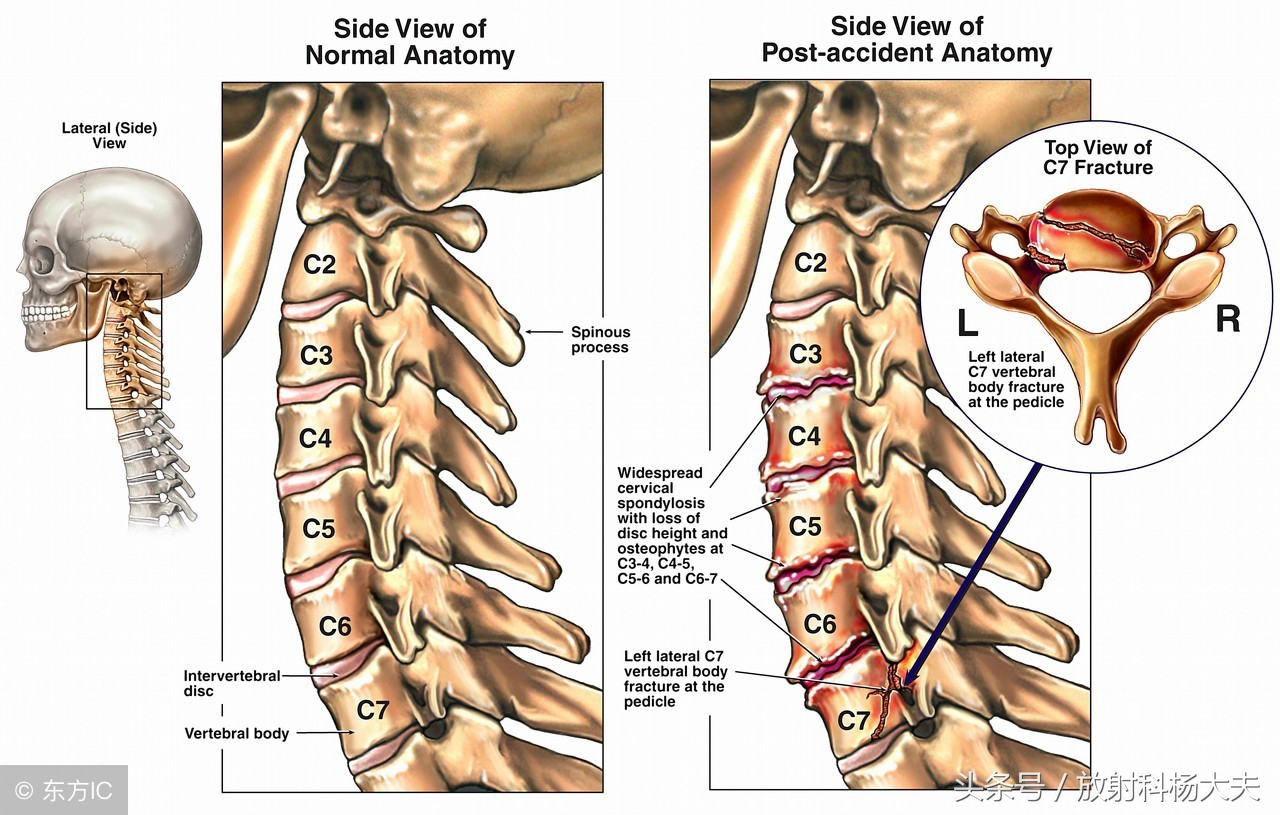 磁共振能不能看出肌肉萎缩,颈椎磁共振能不能看到茎突