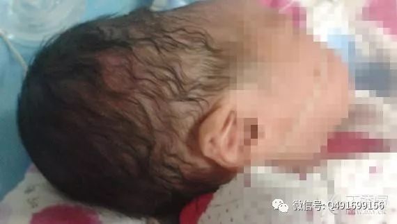 新生儿常见的生理反射有哪些,新生儿特殊生理现象照片